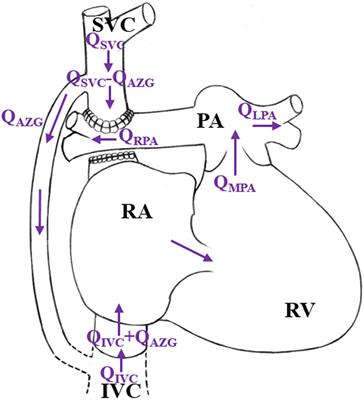 Numerical Simulation of the Effect of Pulmonary Vascular Resistance on the Hemodynamics of Reoperation After Failure of One and a Half Ventricle Repair